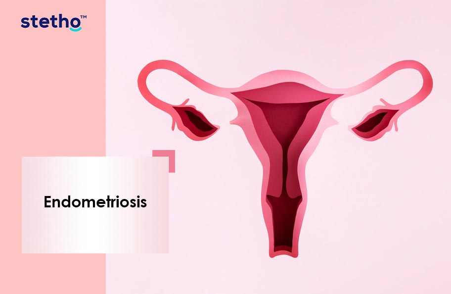 Endometriosis
